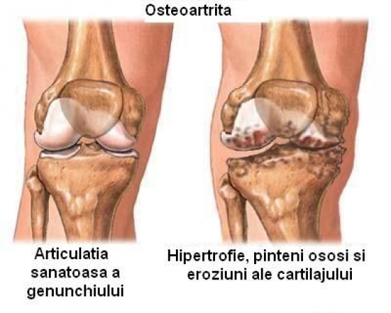 artrita artroso a articulației genunchiului cum se tratează