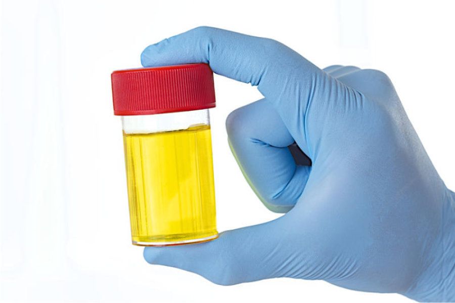culoarea urinei cu indicatori de prostatita